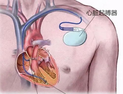 政策解讀 | 進(jìn)口心臟起搏器有哪些監(jiān)管要求？